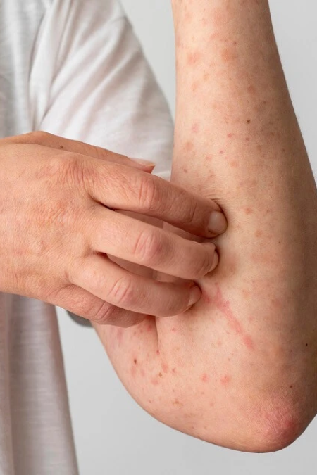 Diagnóstico y tratamiento de alergias respiratorias, alimentarias y de contacto.