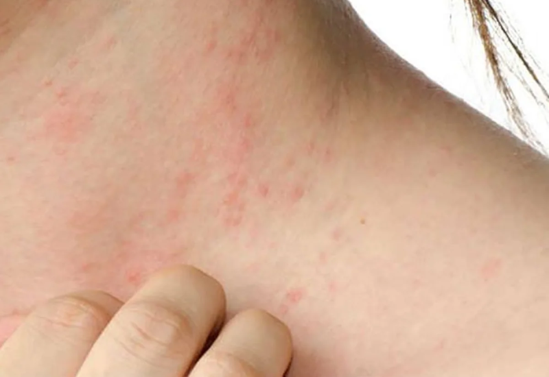 Manejo de la dermatitis atópica con tratamientos para la piel irritada y seca.